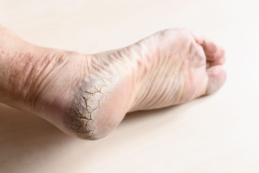 Cracked Heel Treatment - The Barefoot Clinic