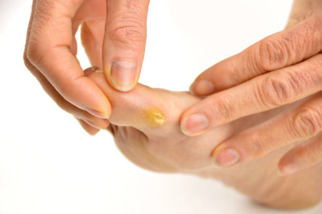 Foot Callus Treatment - The Barefoot Clinic