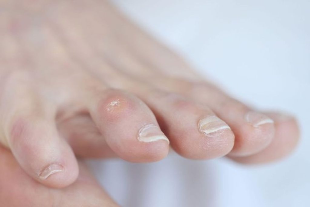 Foot Corn Treatment - The Barefoot Clinic
