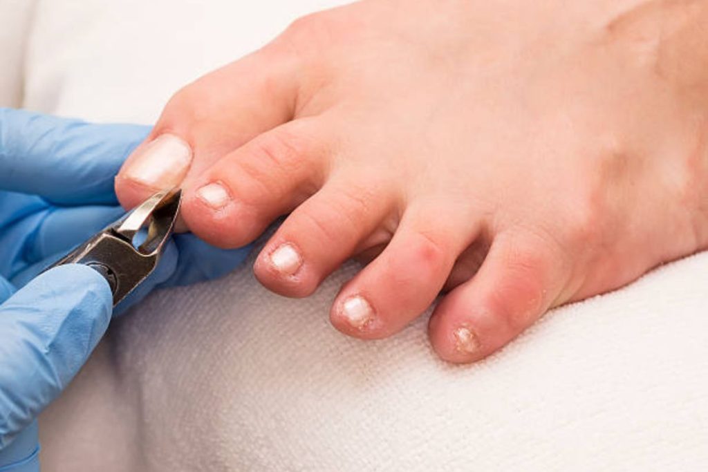 Ingrown Toenail Treatment - The Barefoot Clinic