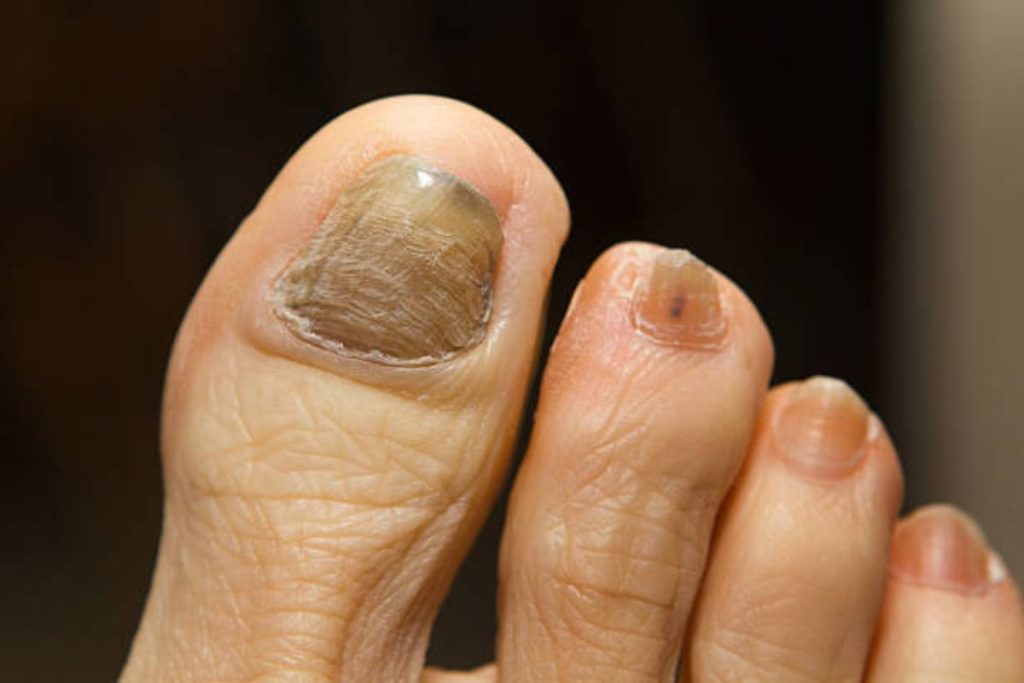 Thickened Toenail Treatment - The Barefoot Clinic