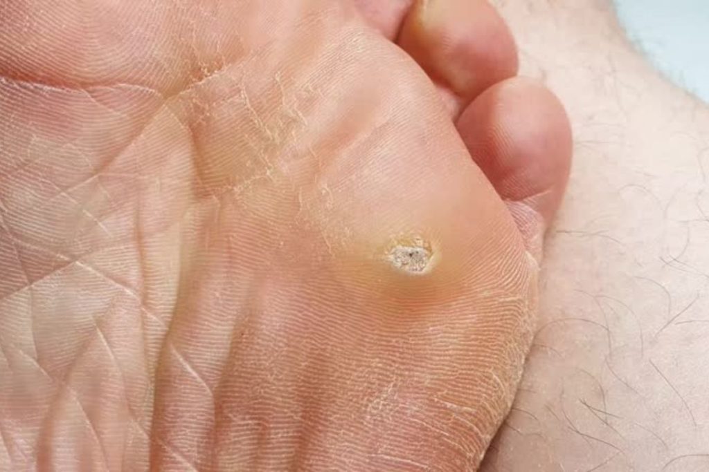 Verruca Treatment - The Barefoot Clinic