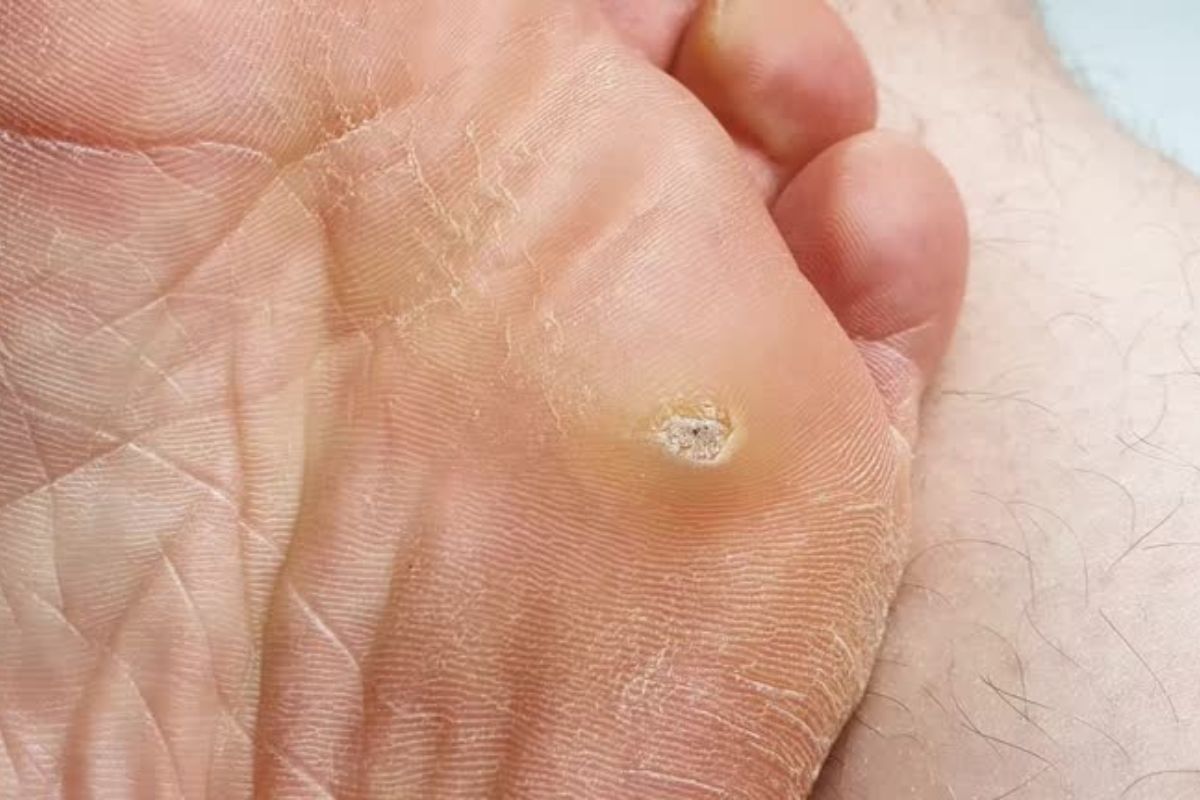 Verruca Treatment - The Barefoot Clinic