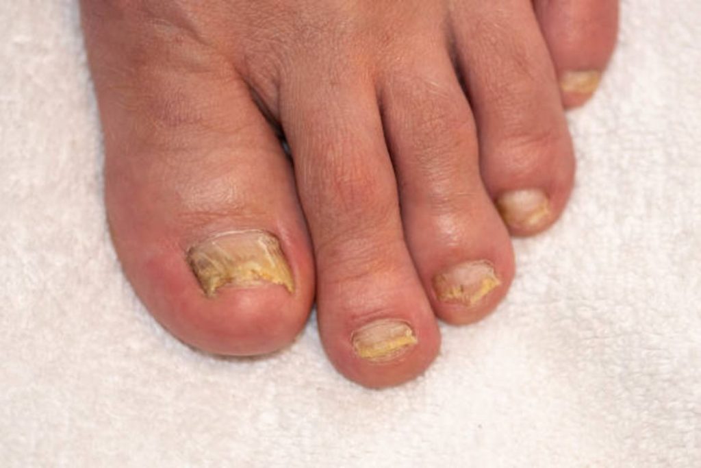 Fungal Foot Infection Treatment - The Barefoot Clinic